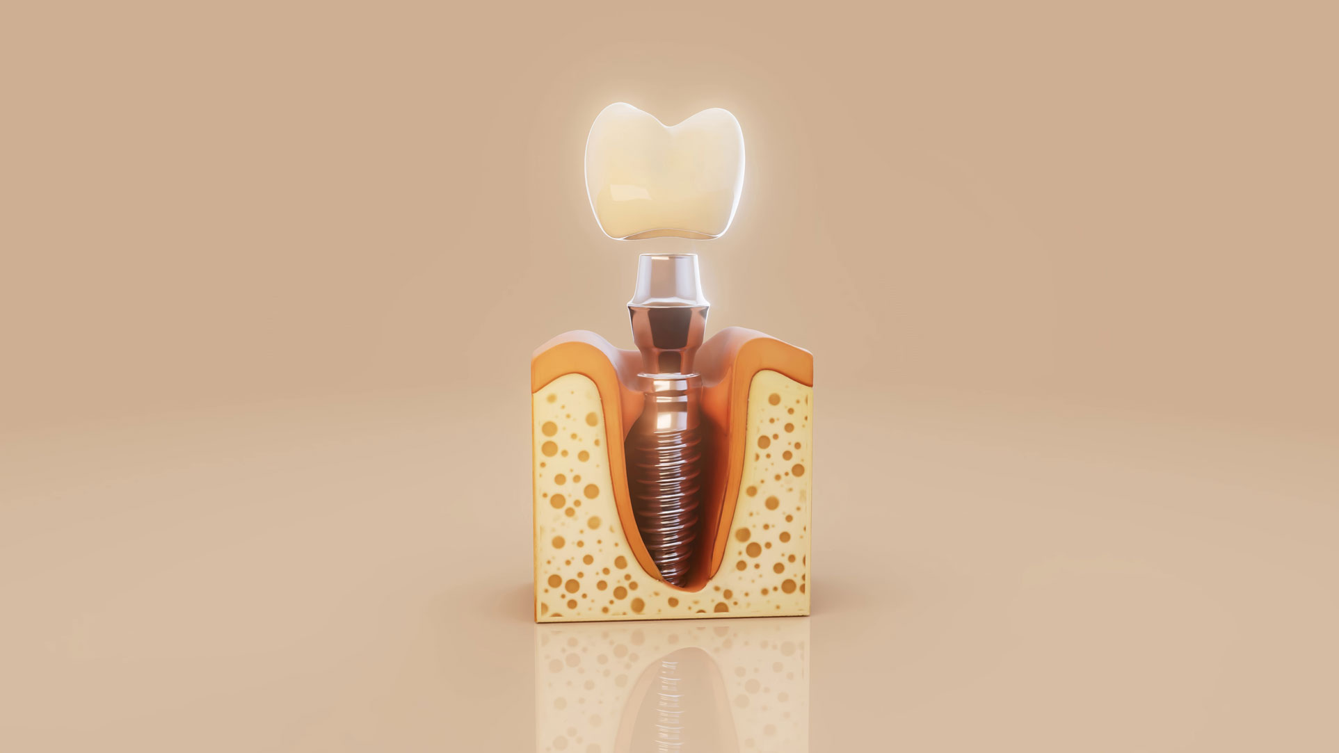 Дентальная имплантация Dentium