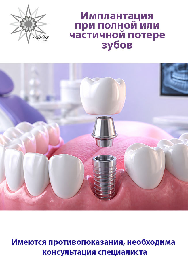 Дентальная имплантация Dentium