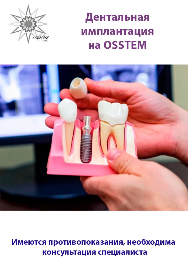 Дентальная имплантация OSSTEM