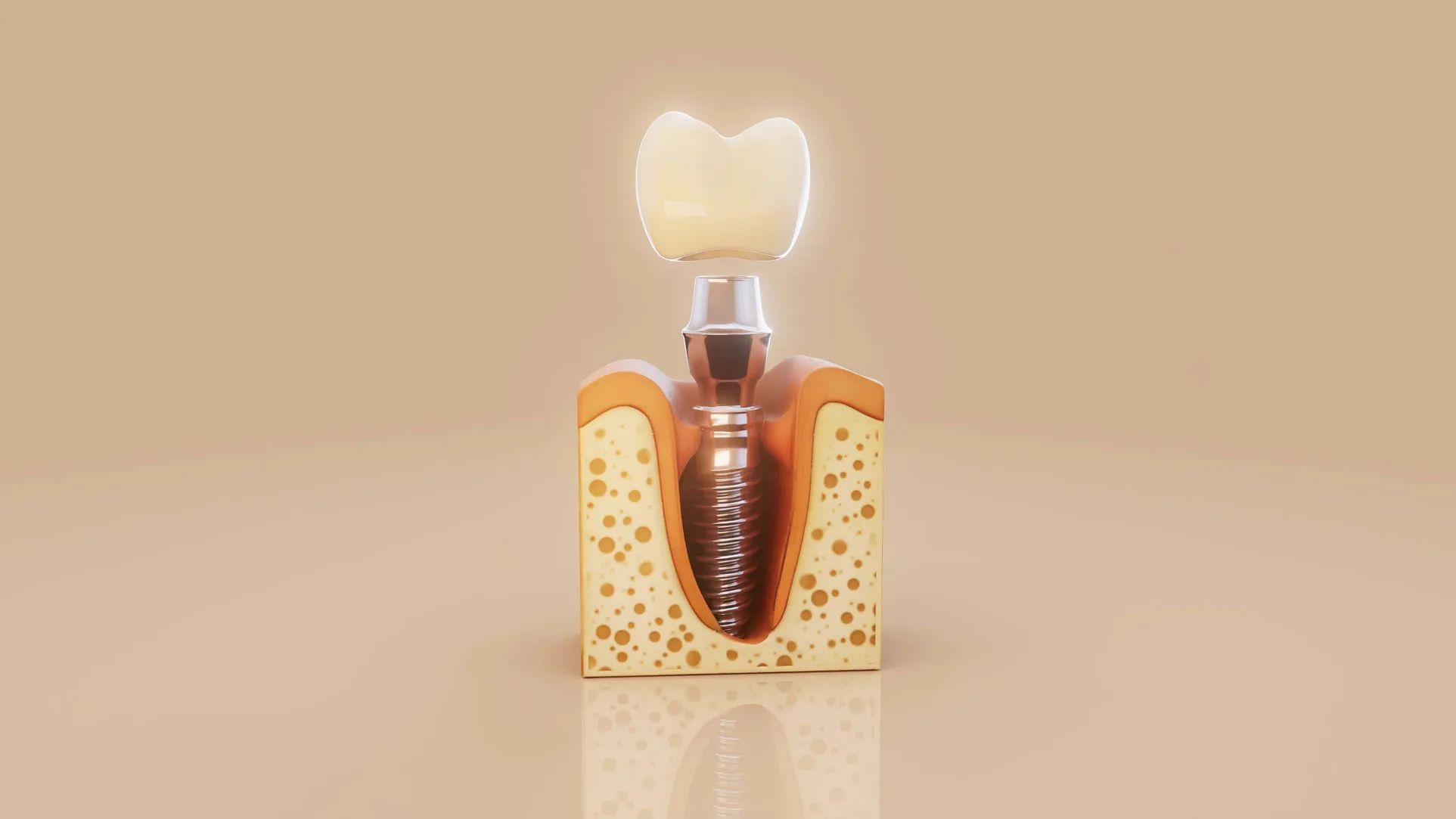 Дентальная имплантация Dentium