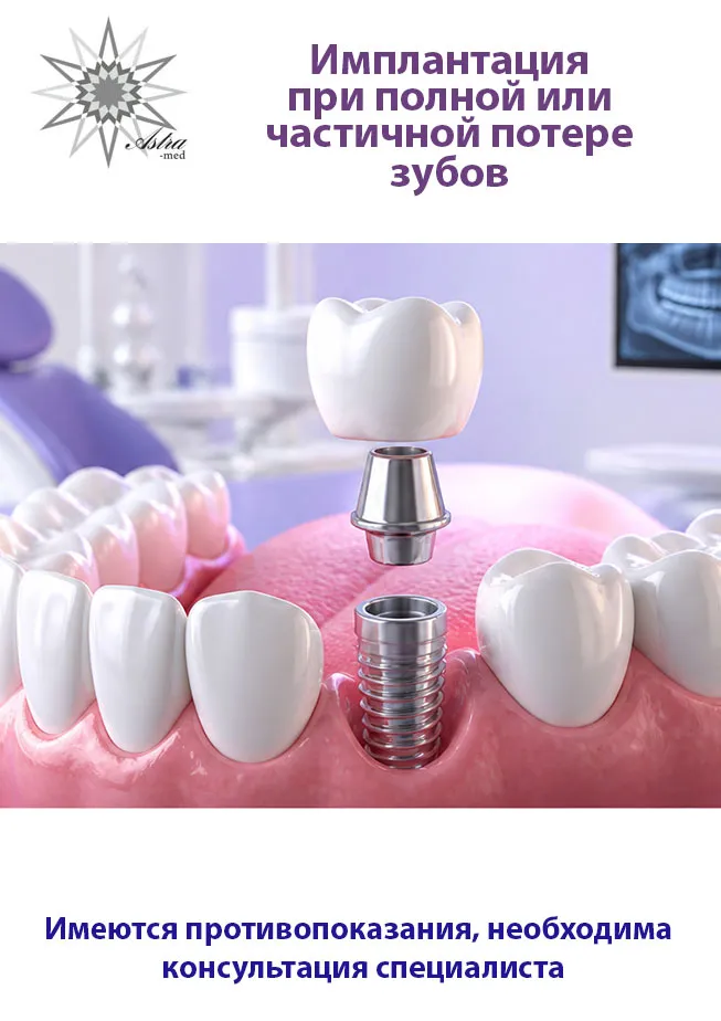 Дентальная имплантация Dentium